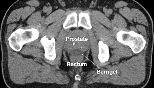 BARRIGEL IMAGES