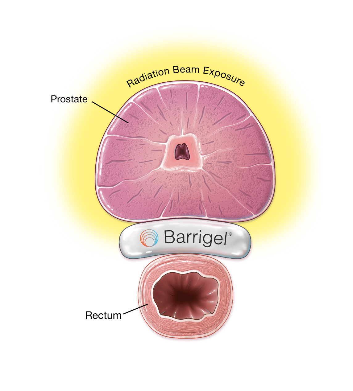 Barrigel Hyaluronic Acid Rectal Spacer